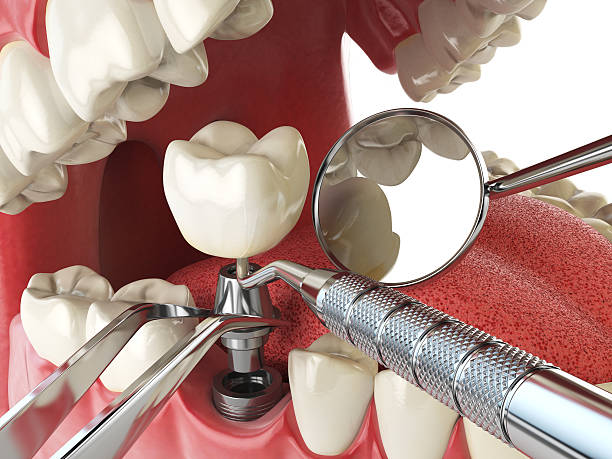 Best Emergency Dental Care for Abscessed Tooth in Experiment, GA