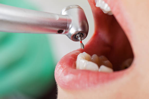 Best Emergency Dentist for Lost Fillings or Crowns in Experiment, GA